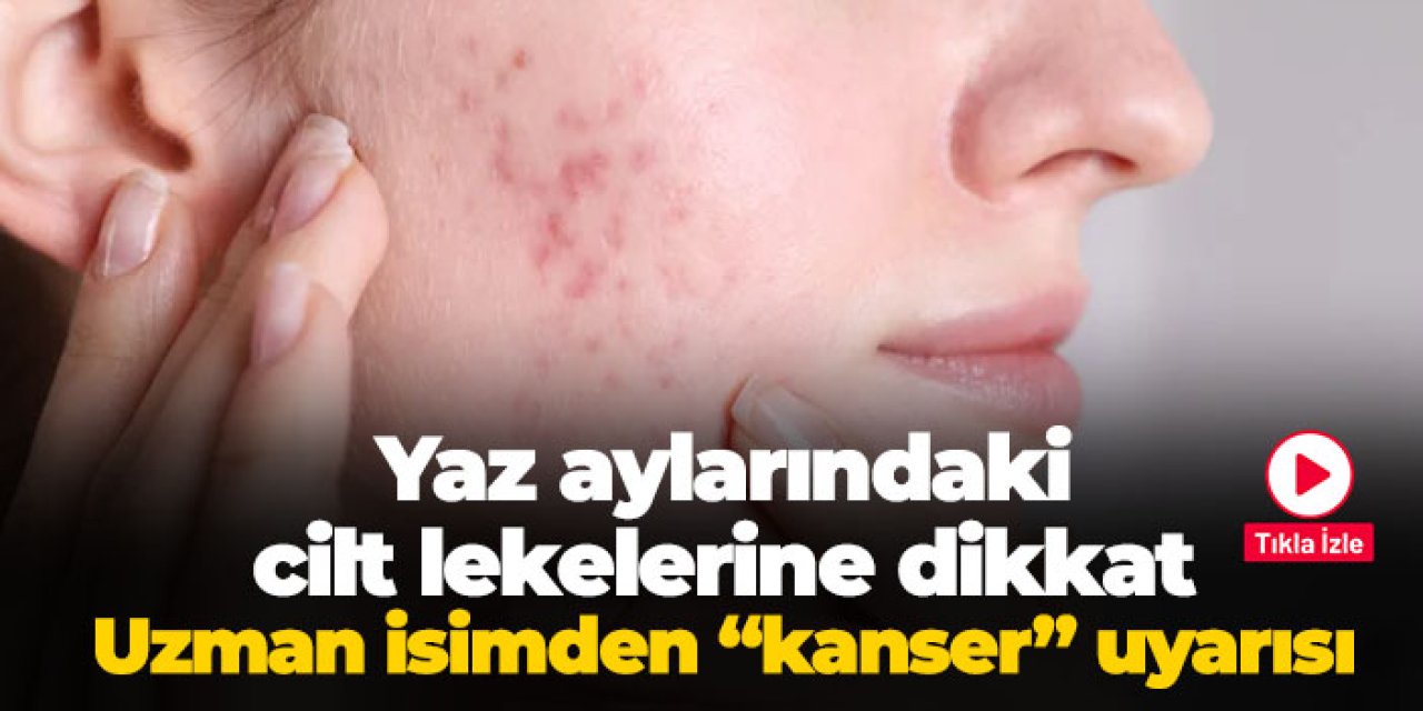 Yaz aylarında cilt lekelerine dikkat! Uzman isimden "kanser" uyarısı