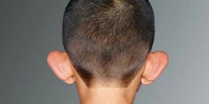 Profesörden çocuklarda kepçekulak sorunu için uyarı