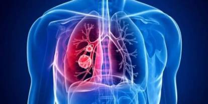 Uzman isimden "sessiz katil" uyarısı! "Öksürük, ses kısıklığı, kanlı balgam..."