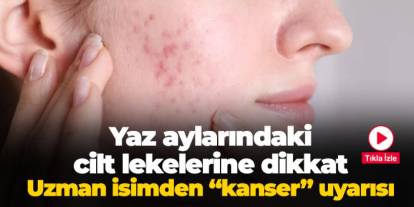 Yaz aylarında cilt lekelerine dikkat! Uzman isimden "kanser" uyarısı